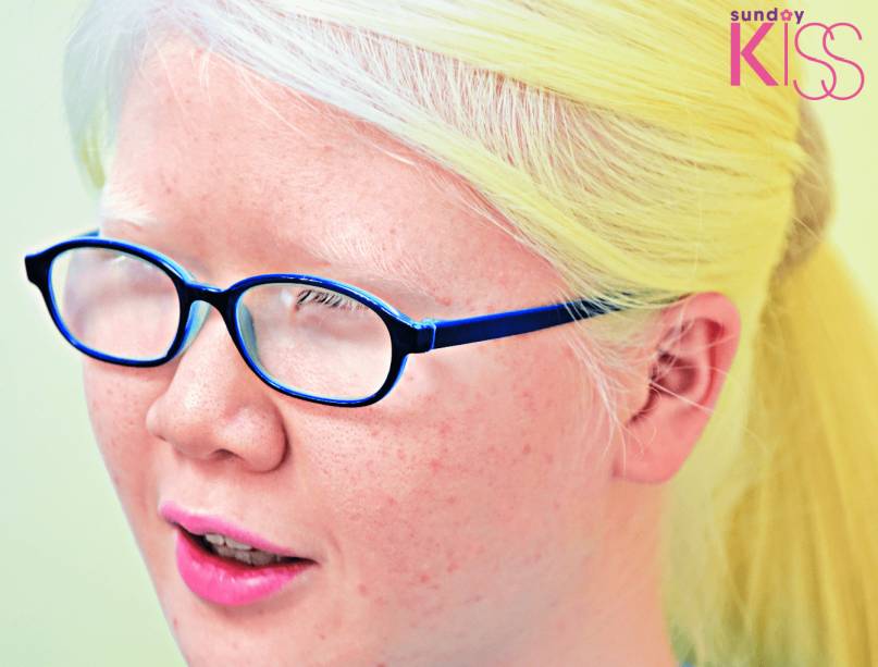 白化病 由於欠缺黑色素，頭髮、眼睫毛呈白色，而皮膚亦白皙。