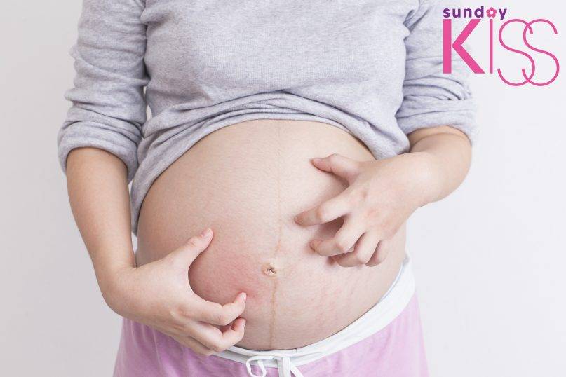 妊娠期間周身痕 不一定是濕疹作怪