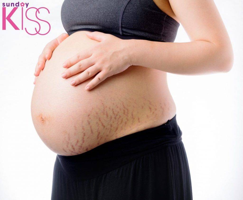 妊娠紋 在中醫的角度，妊娠紋是預防勝於治療。