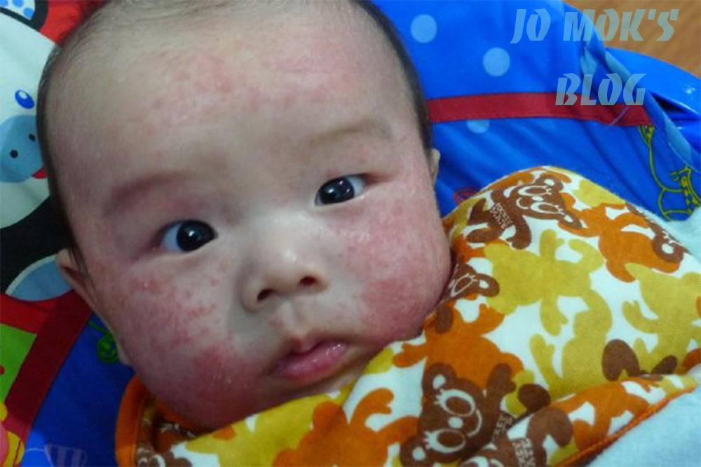 生物共振 兒子歲半前都被濕疹纏繞，成塊面又紅又爛，相中的情況已非最嚴重的程度。