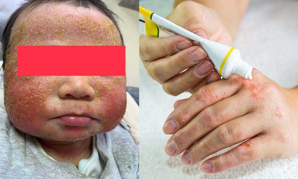 濕疹纏身2個月大嬰兒爛面滲水  西醫提供3大濕疹治療方法