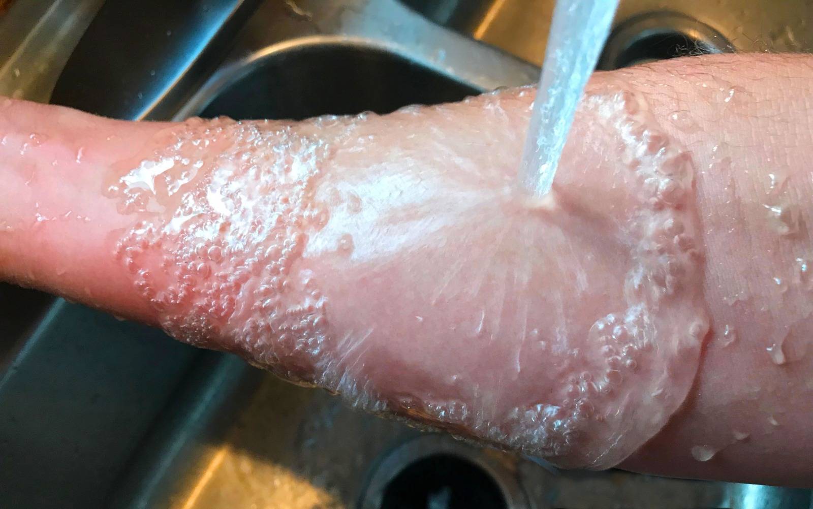 燙傷 將燙傷、燒傷的皮膚放在冷水中浸泡20分鐘，對治療燙傷或燒傷有很大的幫助。