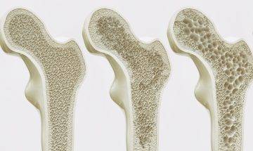 减肥减到骨质疏松 | 营养师教5大预防骨质流失贴士 3日补钙餐单