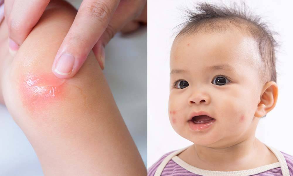 止痕忌用薄荷膏  兒科醫生：2歲以下幼兒不宜  蚊叮蟲咬塗錯膏傷害中樞神經