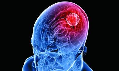 經常頭痛響腦腫瘤警號 六招加快康復進度