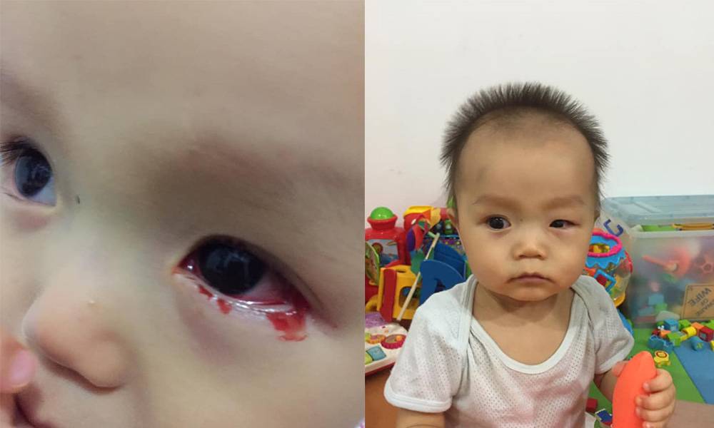 11個月男嬰患紅眼症流血淚 家姐發高燒 弟弟揉眼感染病毒