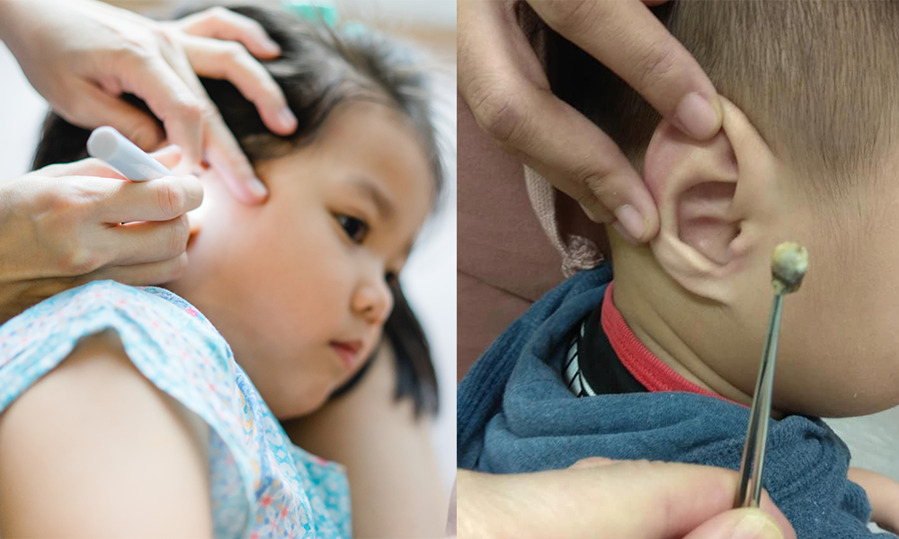 醫生教正確清理耳垢方法 | 3歲小童疑失聰求醫 夾出2cm「巨型耳屎」