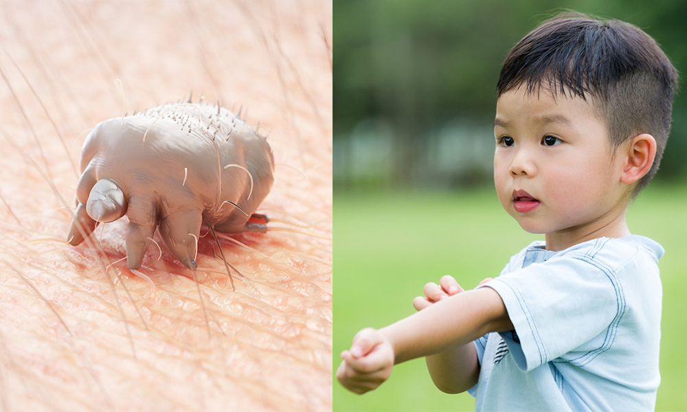 疥瘡傳染力驚人 1歲孩子感染後全身痕癢 手指縫出現「蟲穴道」