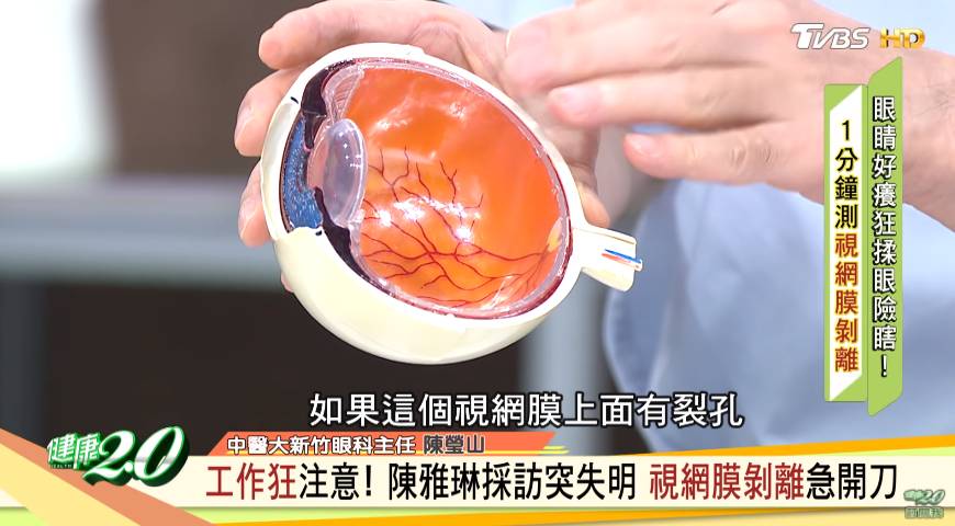 視網膜脫落 視網膜如果有裂孔便會跟眼球密麻麻的血管層分離，造成視網膜脫落。｜圖片來源：健康2.0@YouTube影片截圖