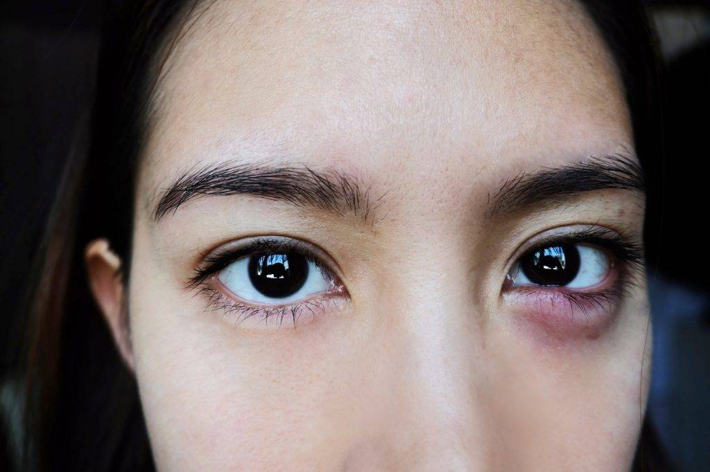 眼瘡種類與治療方法 眼科醫生指捽眼化妝容易誘發眼瘡 幼童及女士屬高危