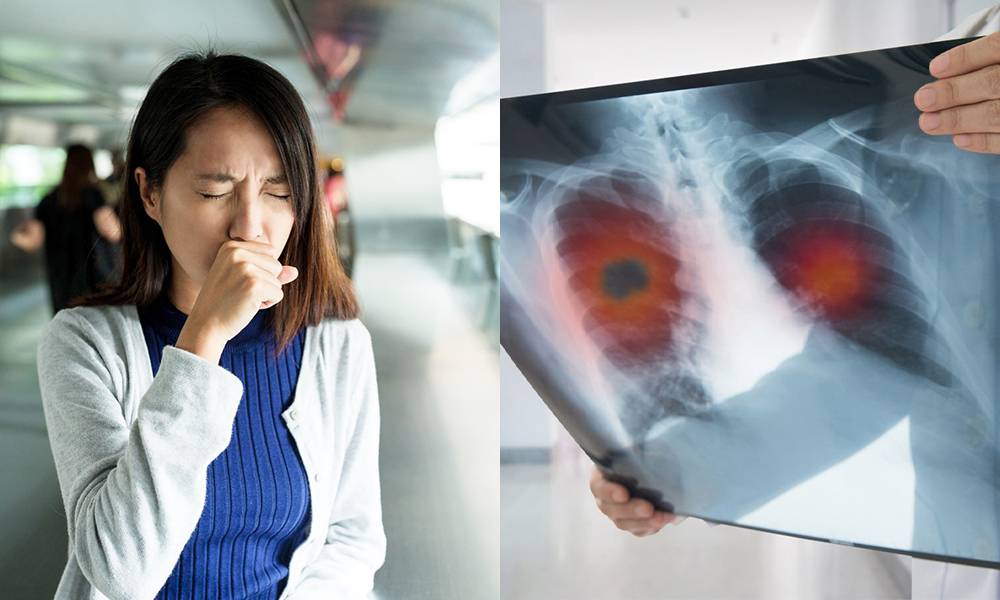 肺癌病徵多樣化不僅咳嗽呼吸不暢 醫生解構2大刻板印象及治療方法