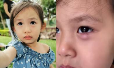 眼挑針成因+預防 困擾8月仍不好 吳日言2歲女 需全身麻醉割眼瘡