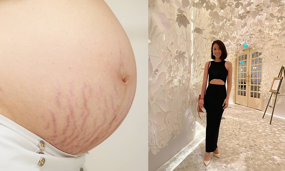 真皮層受損將成永久疤痕 妊娠紋預防勝於治療 2孩媽媽李雪瑩分享保養法