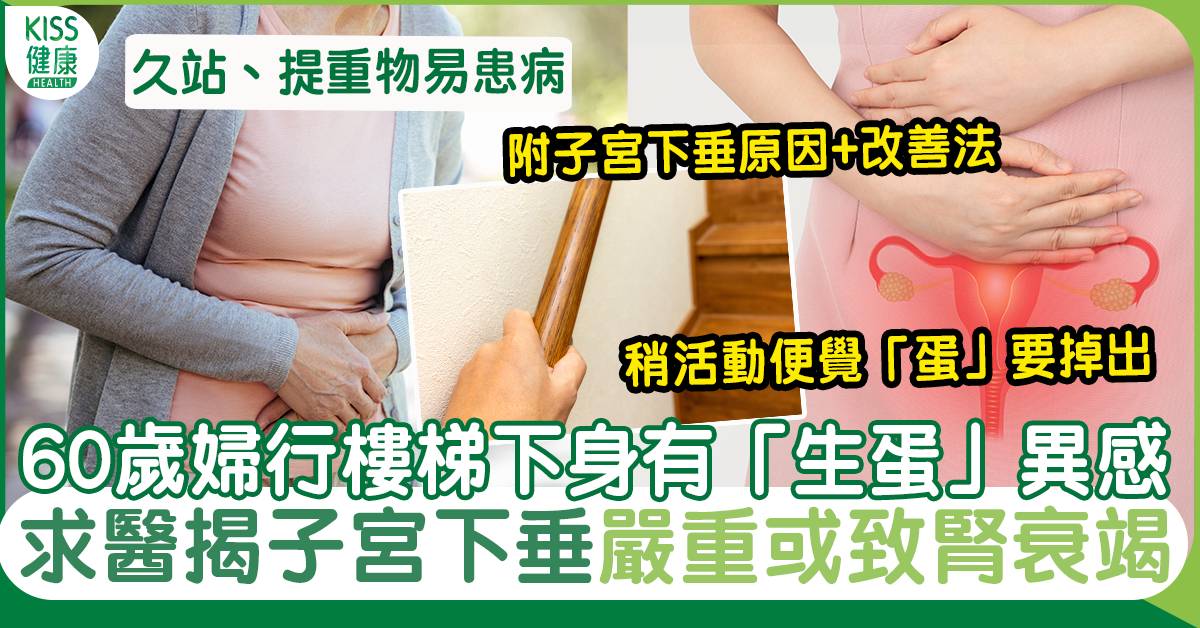 子宮下垂原因+1套運動預防｜60歲婦行樓梯忽有「生蛋」異感 醫：子宮掉出來