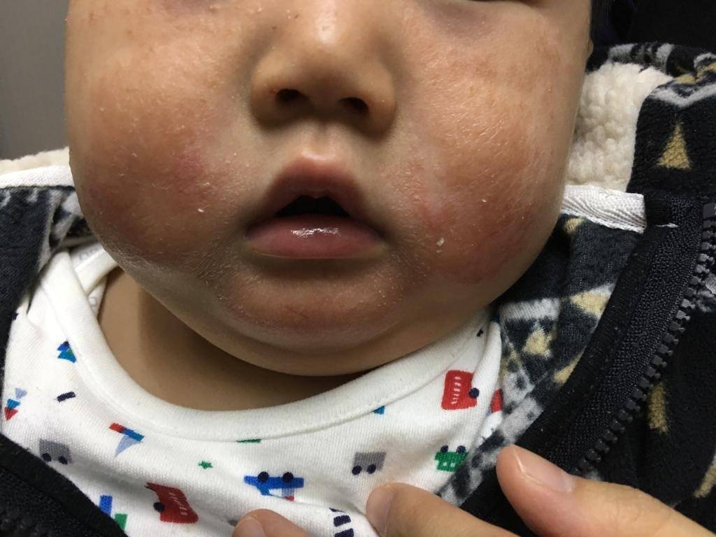嬰兒濕疹（圖片來源：）