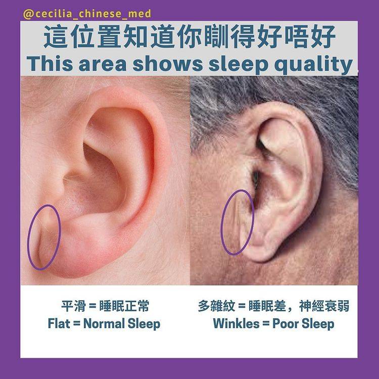 耳珠近面頰位置多雜紋(右圖)，代表血氣不足、睡眠欠佳及精神衰弱。(圖片來源：ig@cecilia_chinese_med)
