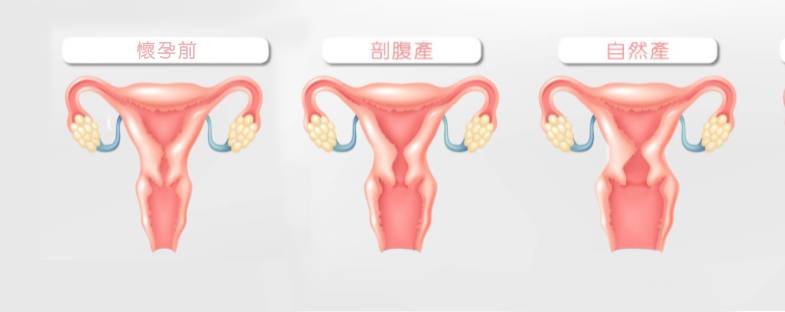 紮肚 女士於懷孕前、開刀後及順產後的陰道示意圖