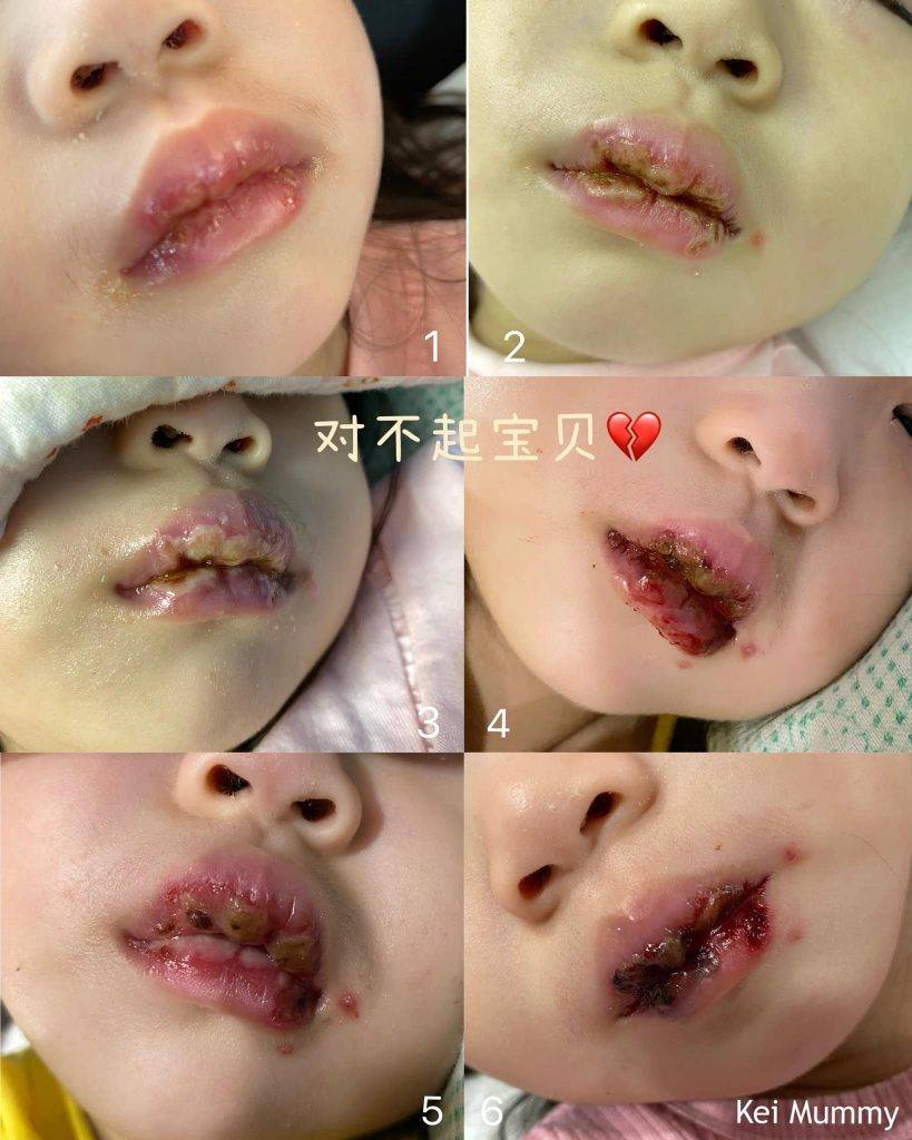 2歲幼兒患唇疱疹，嘴上的水泡