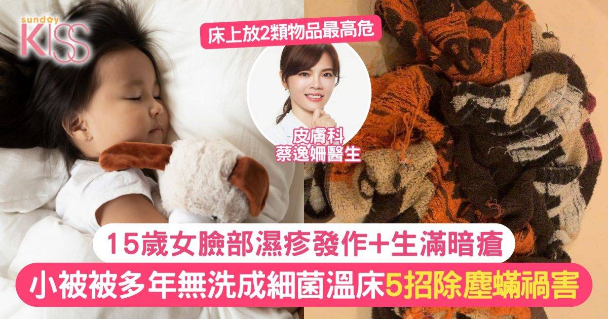 小被被多年無洗成細菌溫床 15歲女臉部濕疹發作+生滿暗瘡 附5招除塵蟎禍害