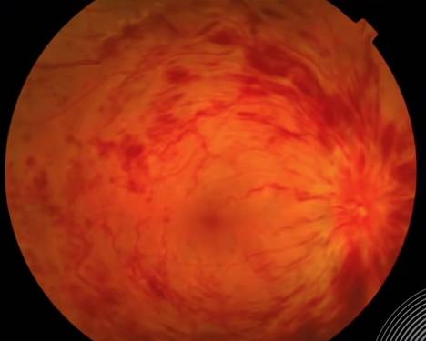 眼中風的視角膜血管情況