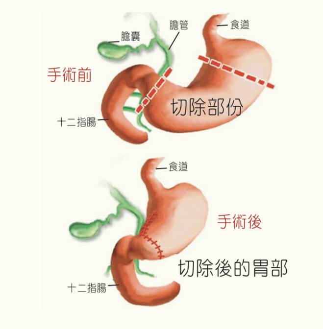 胃癌治療方法主要有胃切除手術為主。