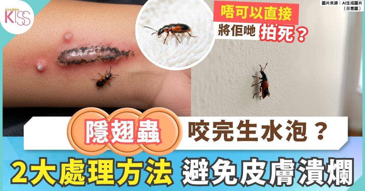 隱翅蟲出沒！傷口呈水泡狀疑含膿：勿損水泡盡快求醫