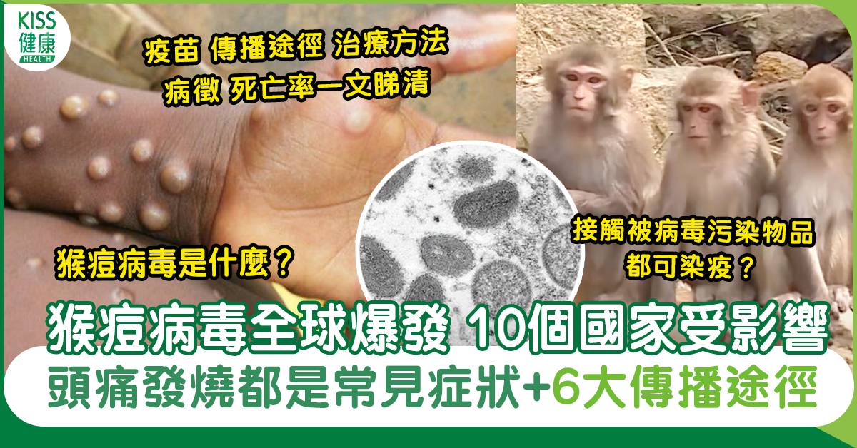 猴痘症狀｜香港大蔓延？來源、疫苗、傳染途徑、治療、死亡率一文睇清！