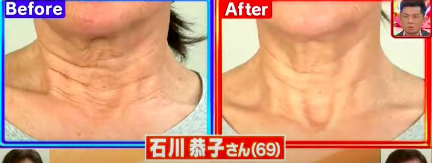 臉部下垂 臉部瑜伽 石川恭子的頸紋改善最明顯。