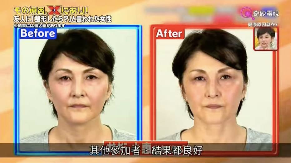 臉部下垂 參與實驗的嘉賓實測3星期後都有不同改善！