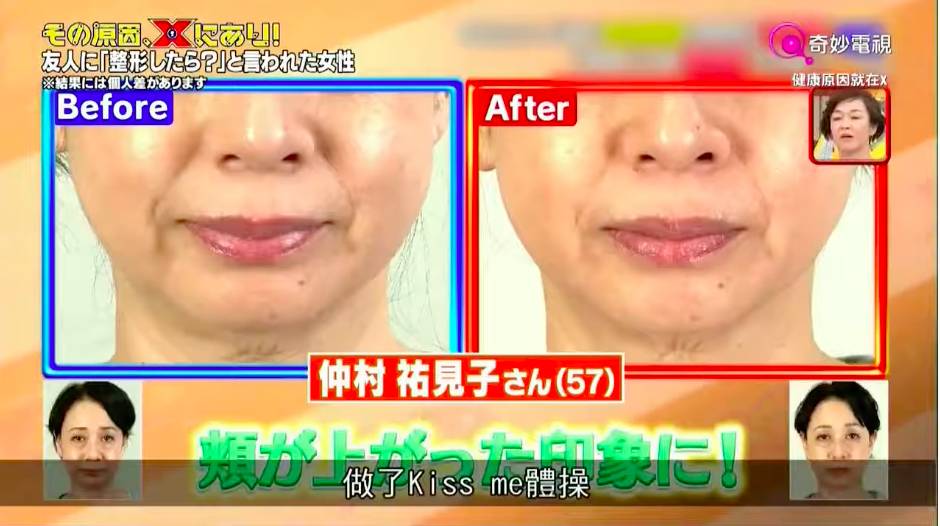 臉部下垂 3星期後顯示法令紋變淺。