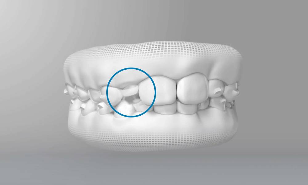 小朋友箍牙 縱然仍在換牙階段，唯隱適美牙箍仍可能預留空間讓恆齒萌出。