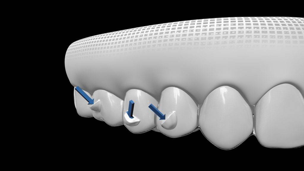 矯齒黃金期 隱適美獨有SmartTrack複合層物料，輕薄柔韌又高彈性，舒適地貼合小朋友牙齒。配合黏在牙齒上 SmartForce附件粒粒，給牙箍施力，毋須金屬鋼線都可以推動牙齒正確移動。