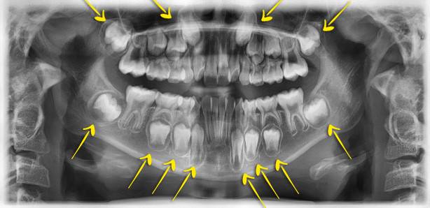 小朋友箍牙 牙醫會利用儀器來估計即將萌出的牙齒狀況如箭咀所示），以便在療程計劃時預留空間給即將萌發的恆齒。