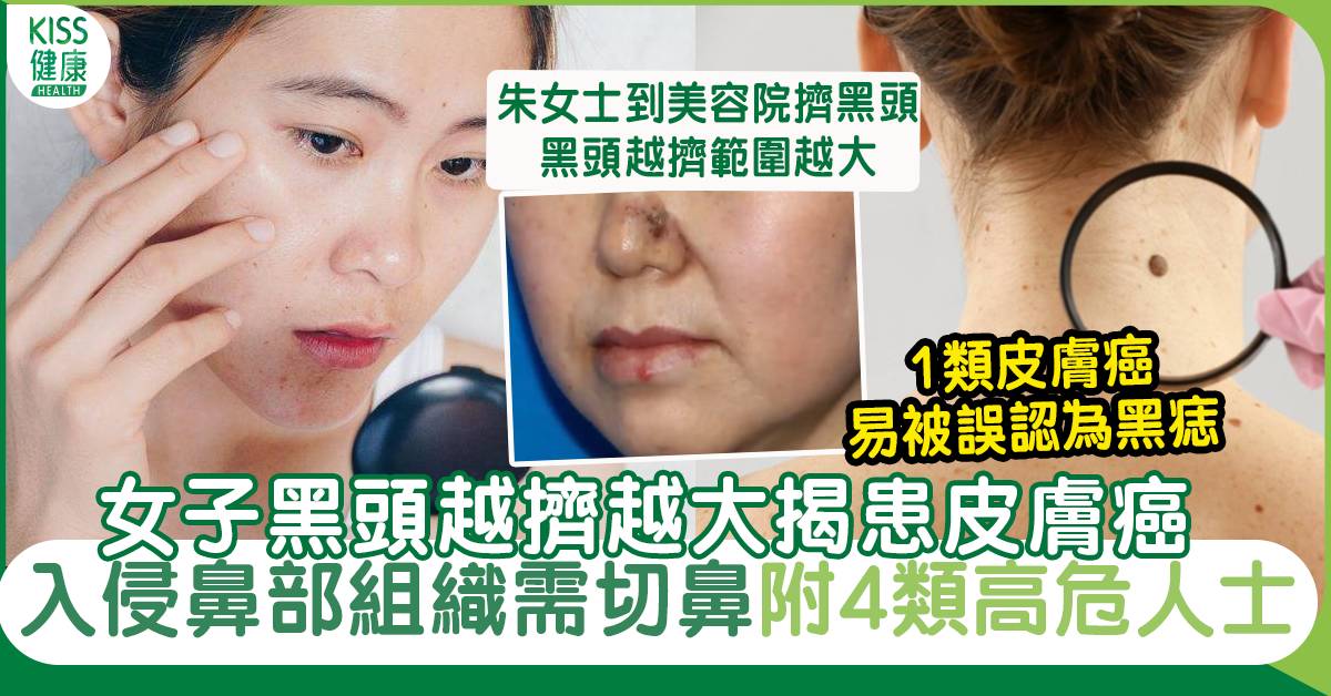 皮膚癌｜女子黑頭越擠越大揭患皮膚癌 入侵鼻部組織需切鼻 附4類高危人士