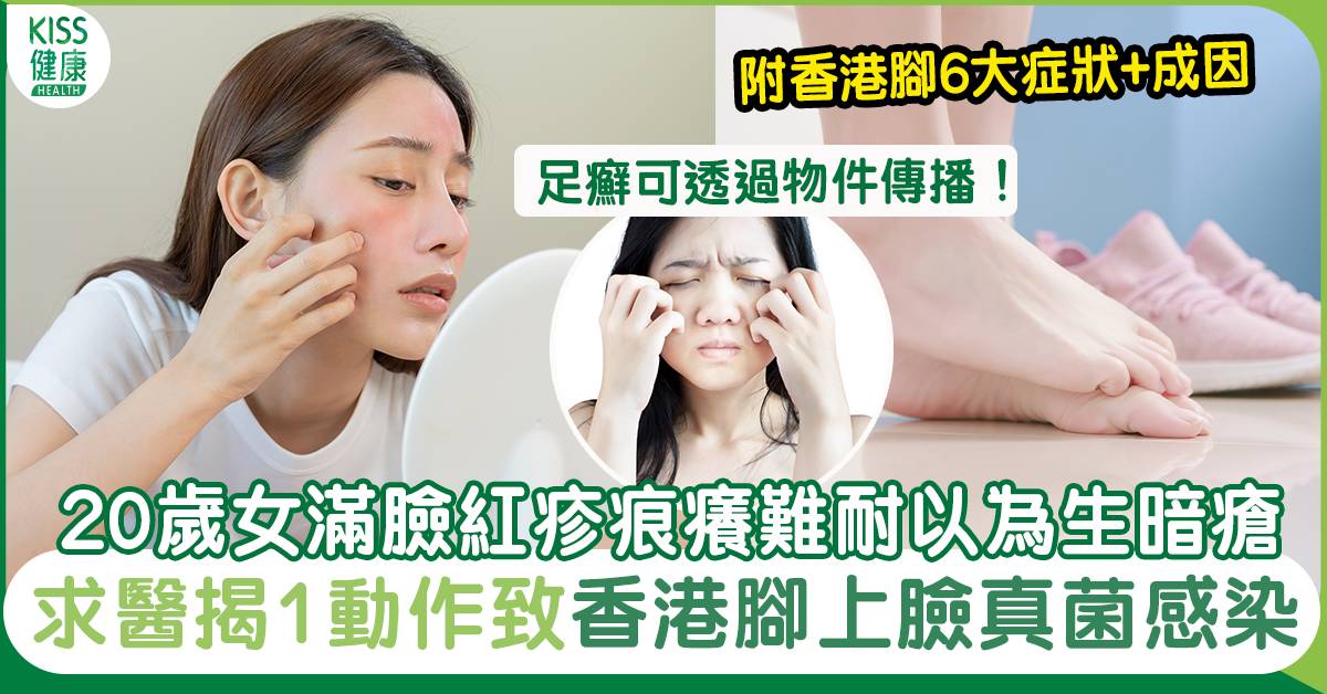 20歲女滿臉紅疹痕癢難耐 求醫揭1動作致「香港腳」上臉 附預防法