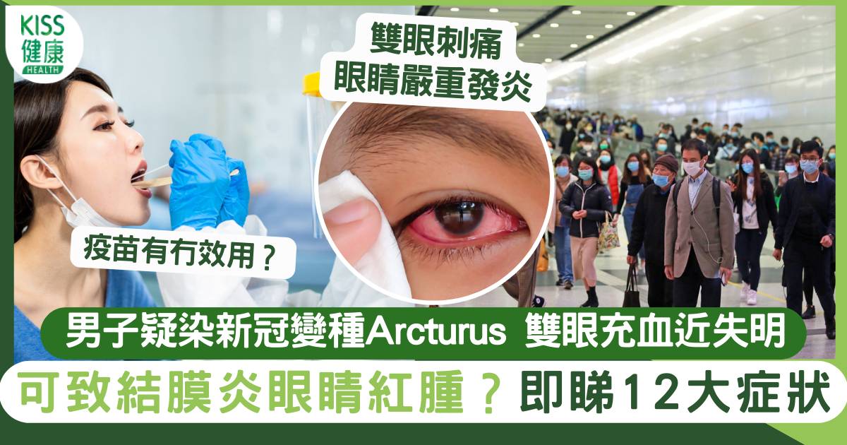 男子疑染新冠變種Arcturus 雙眼充血充血近失明 即睇Arcturus症狀