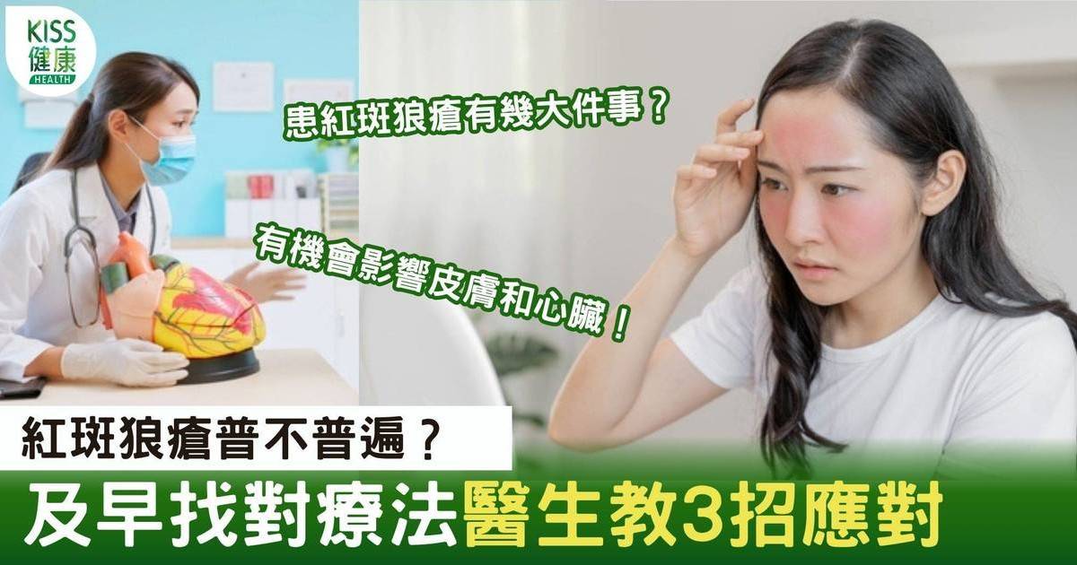 2招防紅斑狼瘡｜愈來愈多香港人患紅斑狼瘡 醫生教3方法處理