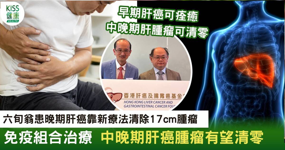 六旬翁患晚期肝癌被指剩半年命 免疫組合治療成功清除17cm腫瘤