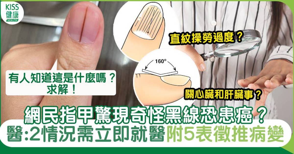 指甲黑線恐患癌？指甲狀態推病變、2大情況需盡快就醫！附護甲湯水