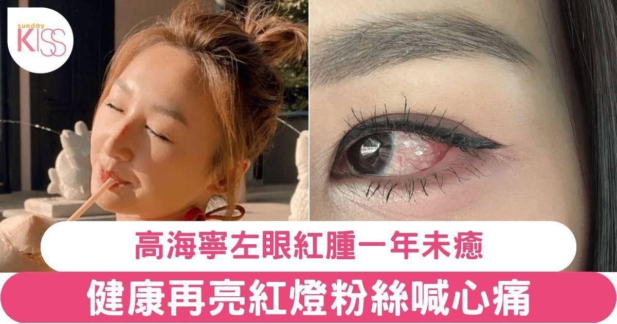 高海寧左眼紅腫一年未癒 健康再亮紅燈粉絲喊心痛 揭劇組經歷最離譜事件