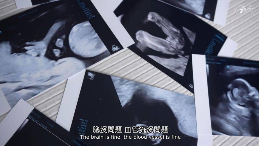 林芊妤 二胎 最新報告結果顯示林芊妤腹中胎兒的腦部、血管流動、五官及身體結構均正常,患有T13的機率低於萬分之一。(圖片來源:YouTube@Coffee林芊妤)