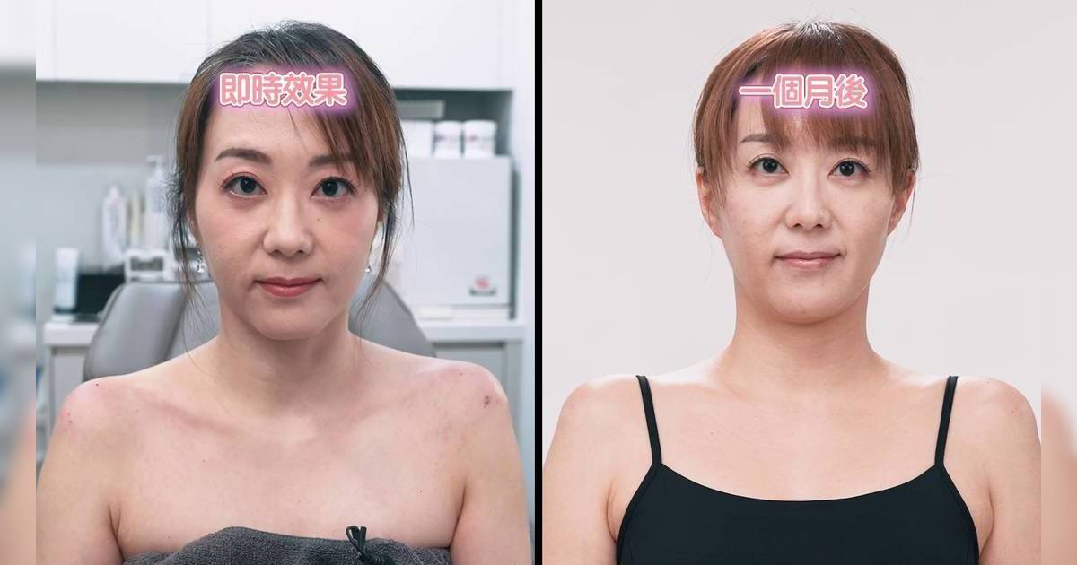 醫美直擊 首爾篇｜《中年好聲音》呂卓欣挑戰「直角肩」！硬食玩具針筒粗針畫面極震撼