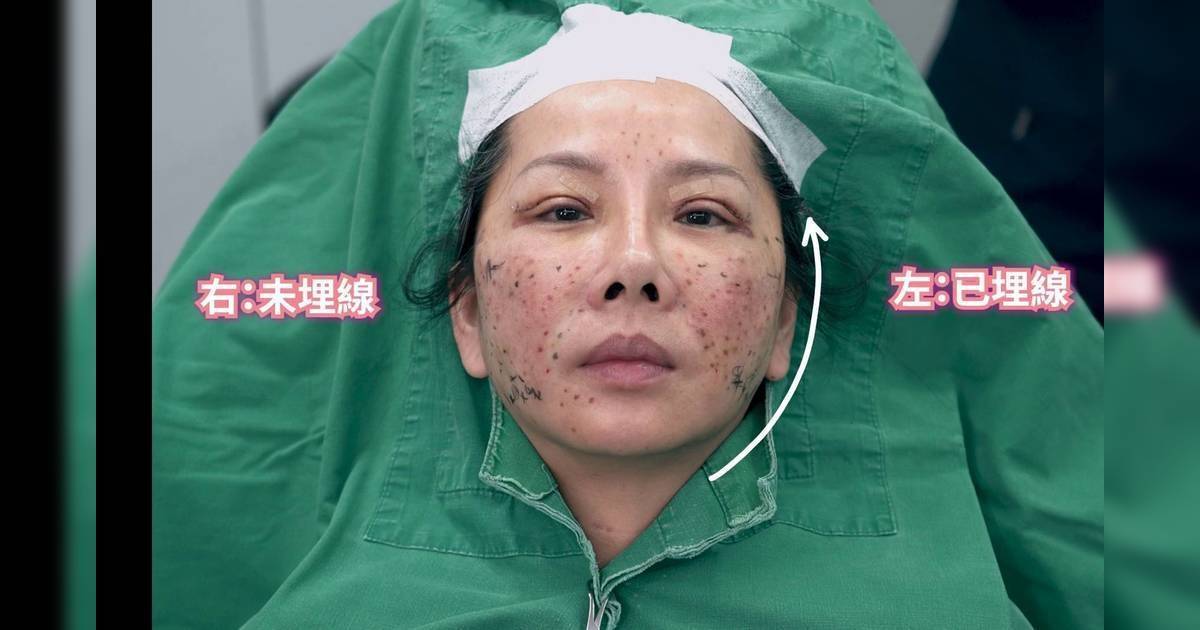 醫美直擊 首爾篇｜「神力拉提」埋線大解構！唔使開刀即時逆齡？陳嘉佳驚呼：視覺好震撼