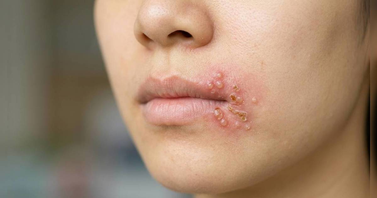 女子嘴角生皰疹 入院當晚宣告不治 醫生揭恐怖真相：現三大症狀須立即求醫