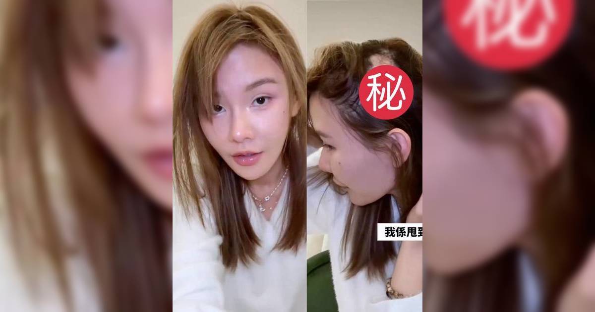 「最強小三」五索自爆「鬼剃頭」再惡化 公開大範圍脫髮照 畫面觸目驚心 醫學解構3大成因