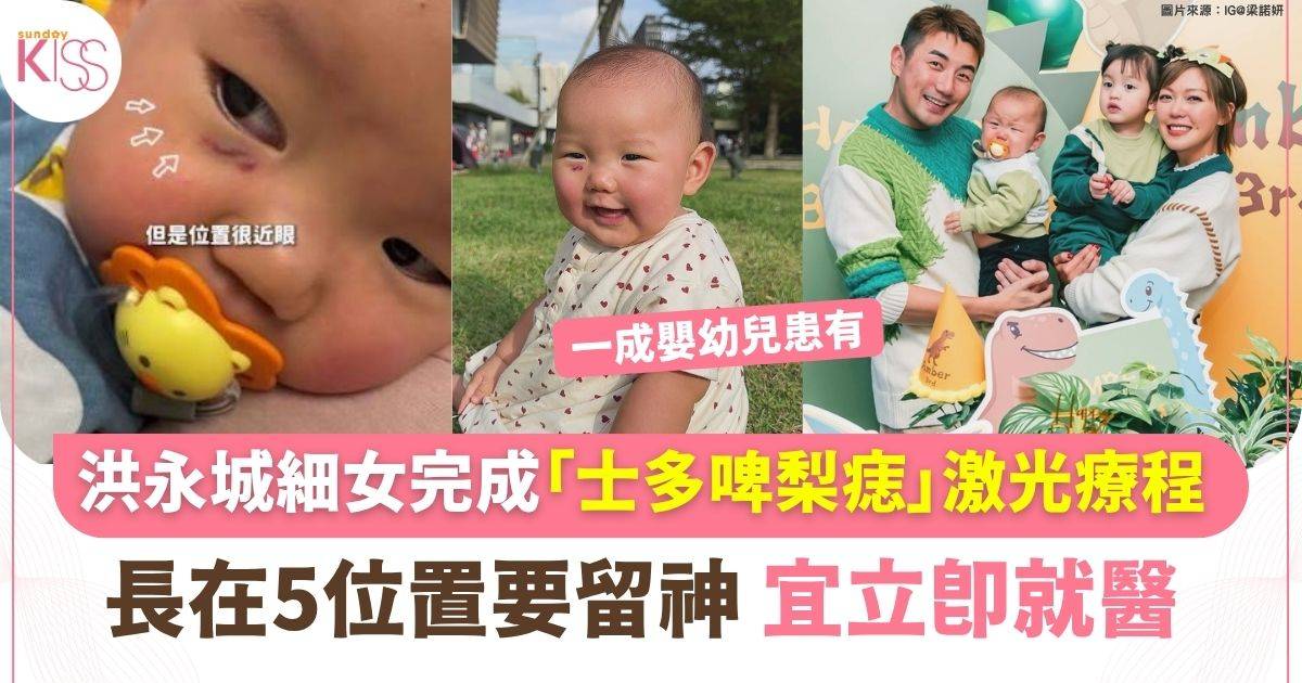 洪永城細女完成「士多啤梨痣」激光療程 長在5位置宜立即就醫